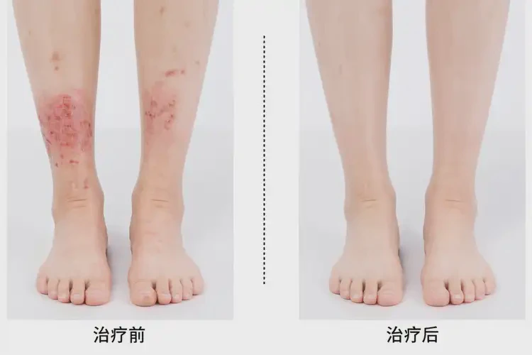 青少年脚上长湿疹能够彻底治愈吗(图4)