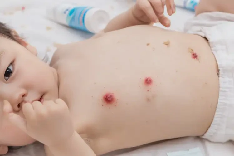 幼兒肚子經(jīng)常長濕疹不管它會自己好嗎(圖4)