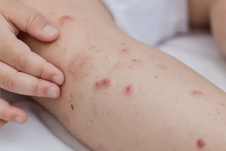 兒童四肢經(jīng)常起濕疹不管它會自己好嗎(圖4)