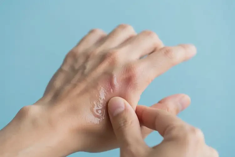 男性手上偶爾起濕疹可不可以徹底自愈(圖3)