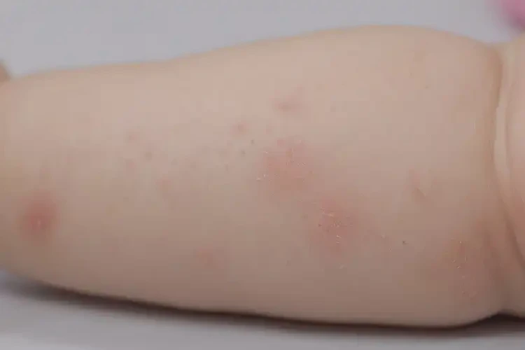 幼兒四肢偶爾長(zhǎng)濕疹不管它會(huì)自己痊愈嗎(圖4)