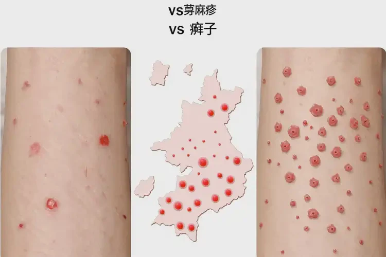 嬰幼兒大腿上偶爾起濕疹不管它會自己痊愈嗎(圖1)