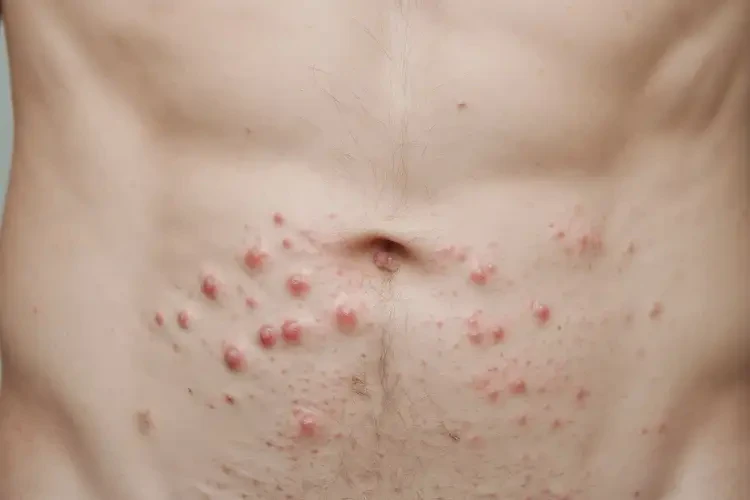 青年人肚子出現濕疹能夠徹底治愈嗎(圖4)