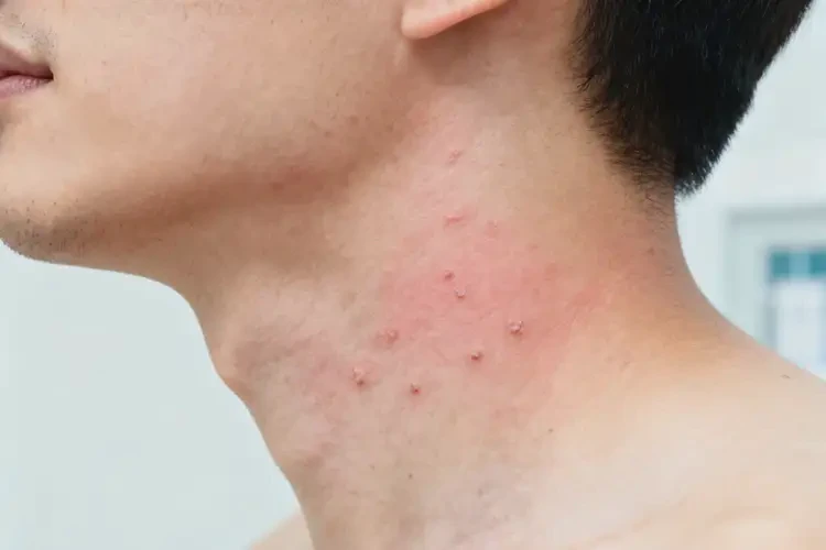 男人脖子上經(jīng)常起濕疹不管它會(huì)自己自愈嗎(圖3)