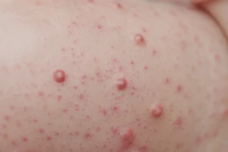 新生兒脖子起濕疹能靠自己自愈嗎(圖4)