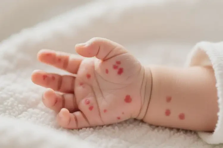 嬰幼兒手上偶爾長(zhǎng)濕疹能靠自己自愈嗎(圖3)