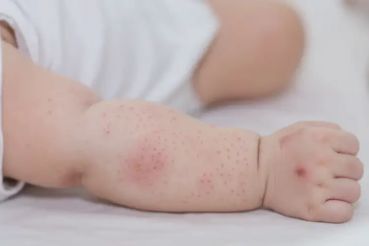 新生兒手臂出現(xiàn)濕疹不管它會(huì)自己好嗎(圖4)