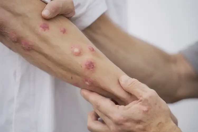 男人四肢偶爾起濕疹不管它會自己好嗎(圖4)