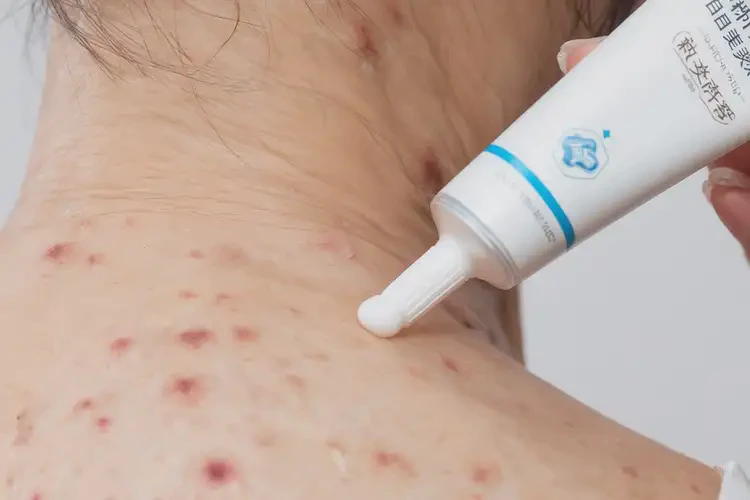 女人脖子上出濕疹能徹底自愈嗎(圖3)