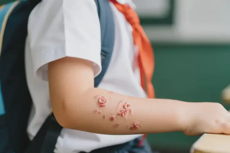 小学生手臂出湿疹能靠自己自愈吗(图2)