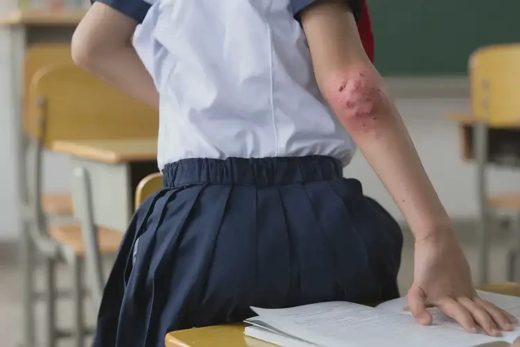 中學(xué)生屁股上容易起濕疹能靠自己自愈嗎(圖4)