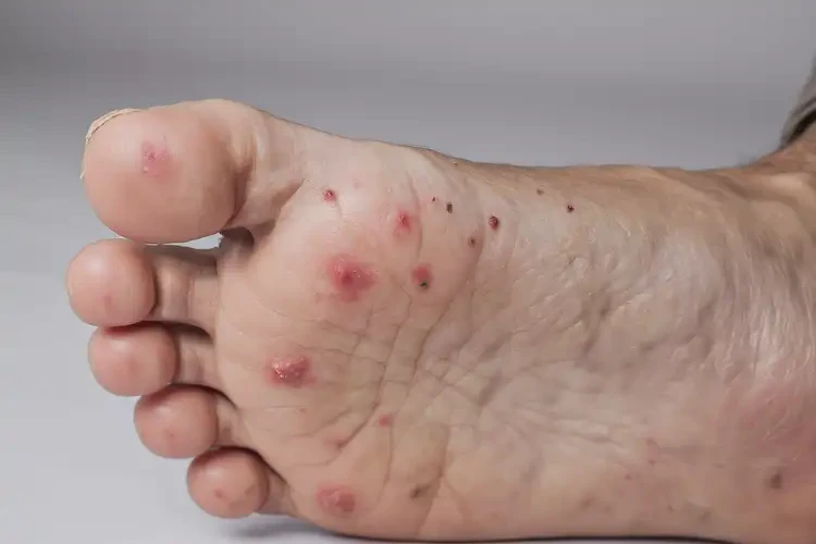 老人腳上容易長(zhǎng)濕疹可以徹底自愈嗎(圖4)