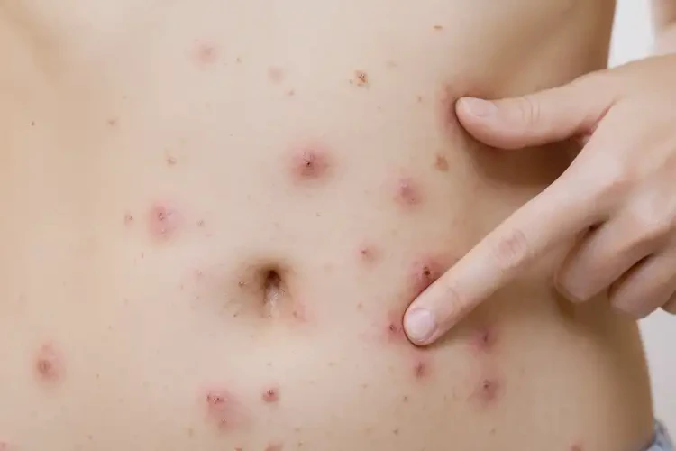 女性肚子上長濕疹能夠徹底治愈嗎(圖4)