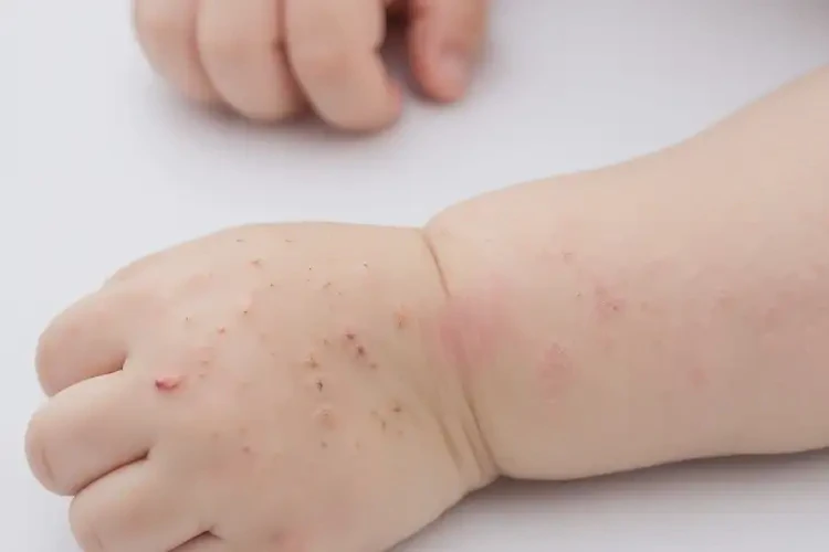 孩子手臂上偶尔起湿疹能靠自己自愈吗(图4)