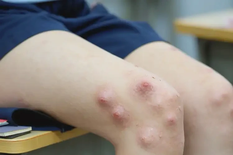 中學(xué)生大腿上出現(xiàn)濕疹能靠自己自愈嗎(圖4)