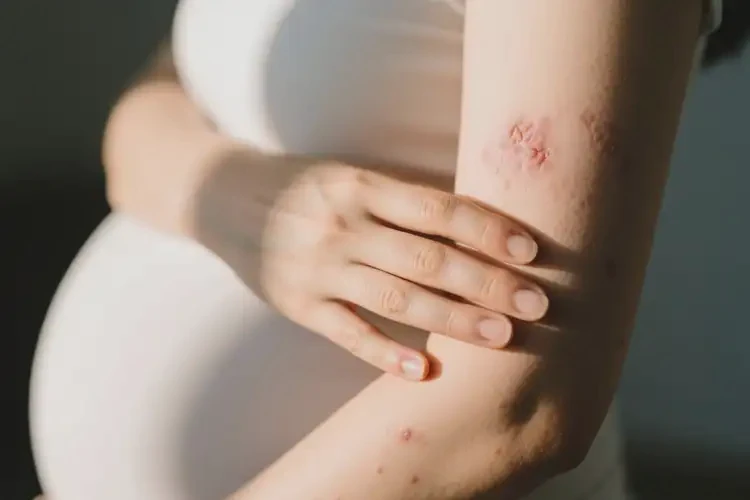 產(chǎn)婦手臂容易起濕疹可以徹底自愈嗎(圖1)
