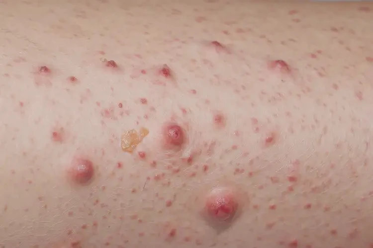 中学生小腿上容易长湿疹能够彻底治愈吗(图4)