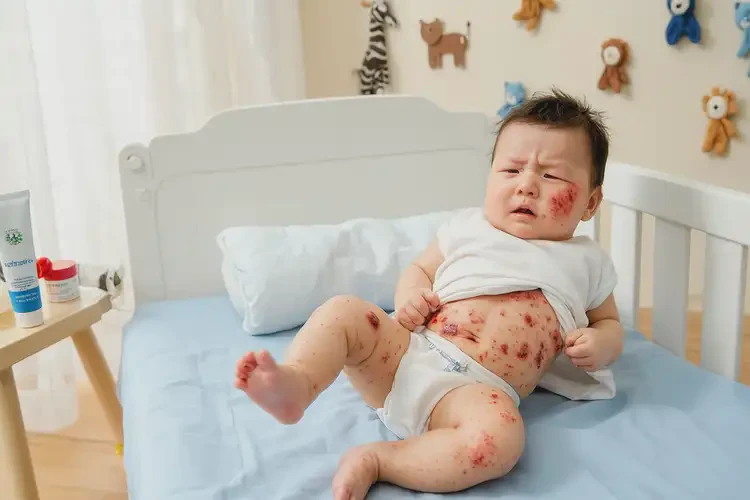 嬰兒肚子經(jīng)常長濕疹不管它會自己痊愈嗎(圖4)