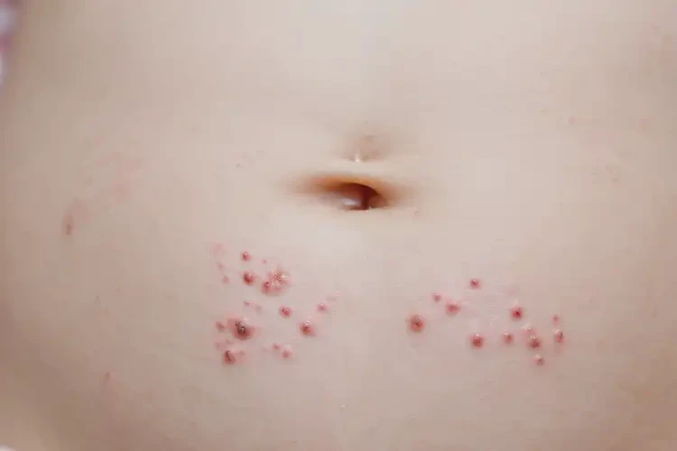 小兒肚子容易長(zhǎng)濕疹能靠自己自愈嗎(圖4)