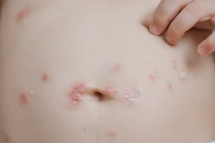 少兒肚子上起濕疹能靠自己自愈嗎(圖4)