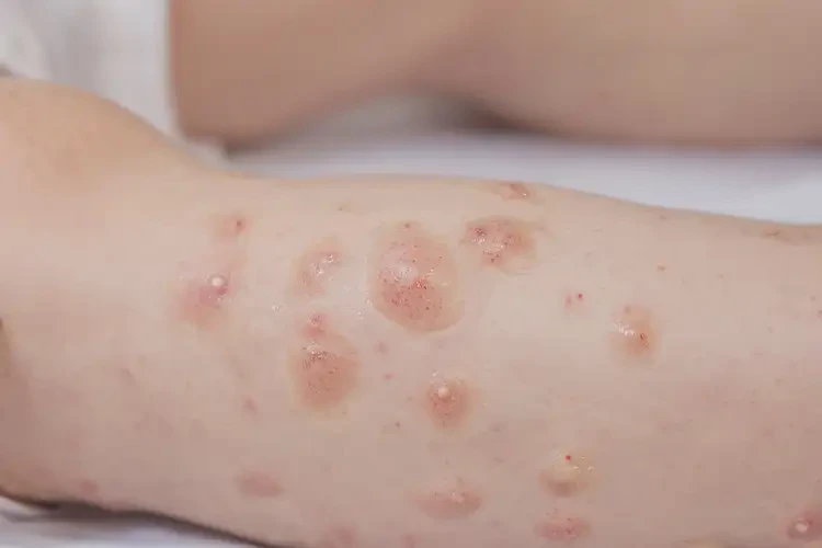 孩子小腿上容易長濕疹不管它會自己痊愈嗎(圖4)
