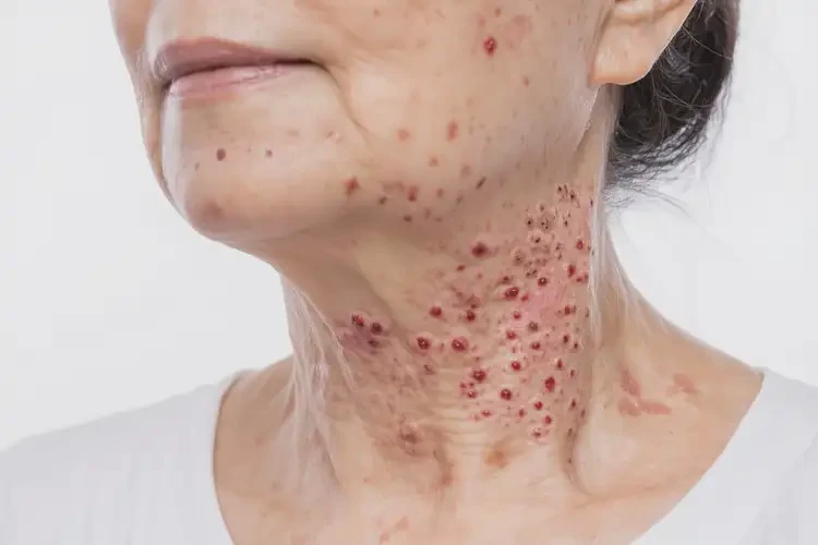 女人脖子长湿疹能不能彻底自愈(图4)