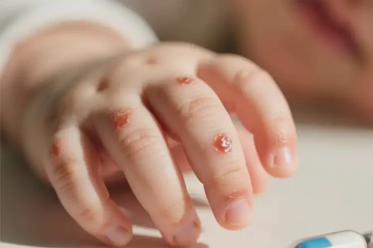 嬰幼兒手上偶爾長(zhǎng)濕疹能靠自己自愈嗎(圖1)