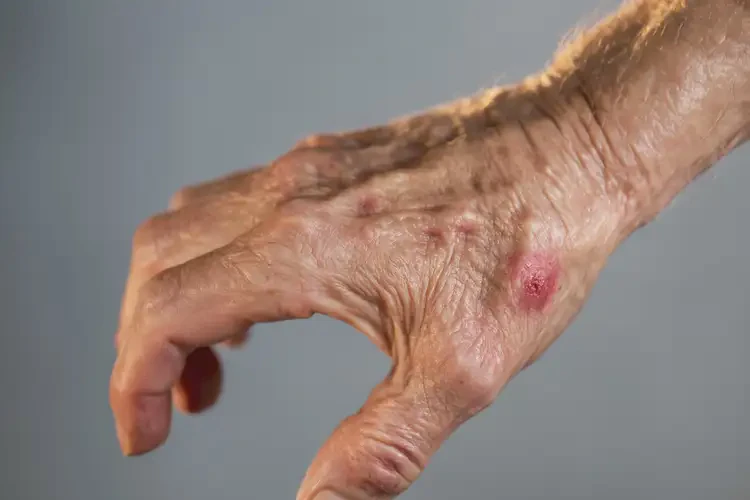 老年人手上容易長(zhǎng)濕疹不管它會(huì)自己自愈嗎(圖4)