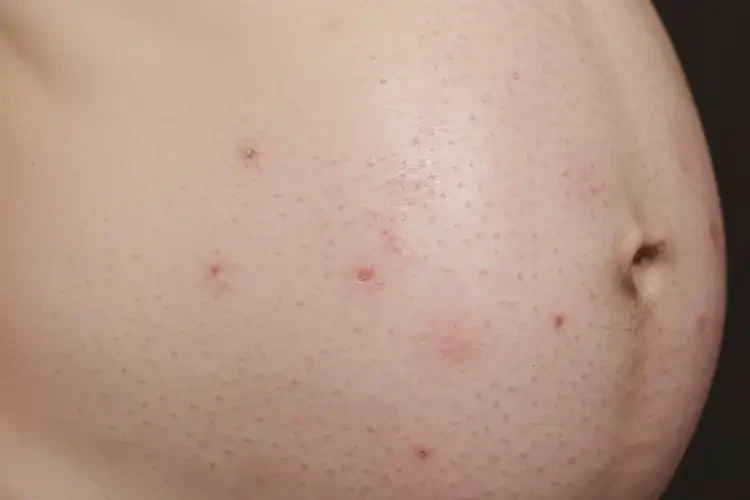 孕妇身上出现湿疹不管它会自己痊愈吗(图4)