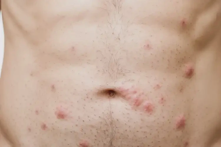 男人肚子上偶爾長(zhǎng)濕疹能徹底自愈嗎(圖4)