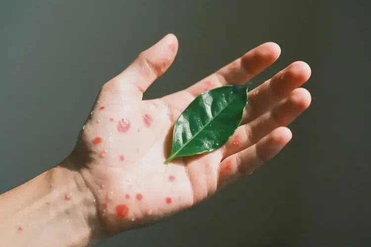 青年人手臂上起濕疹可不可以徹底自愈(圖3)