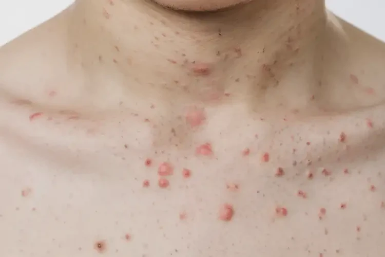 青少年脖子上出濕疹能不能徹底自愈(圖4)