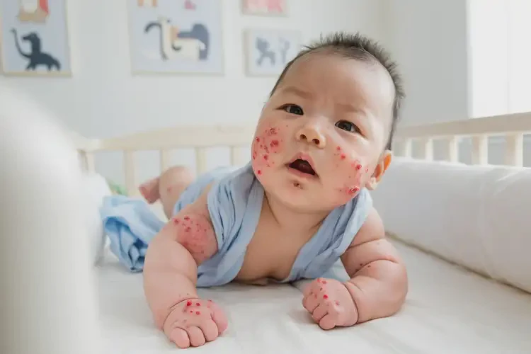 嬰兒屁股出現(xiàn)濕疹能徹底自愈嗎(圖4)