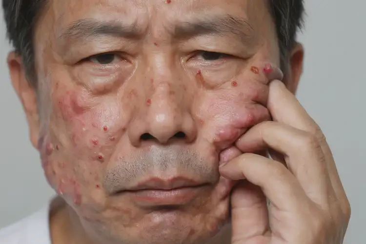 男性面部長濕疹能靠自己自愈嗎(圖4)