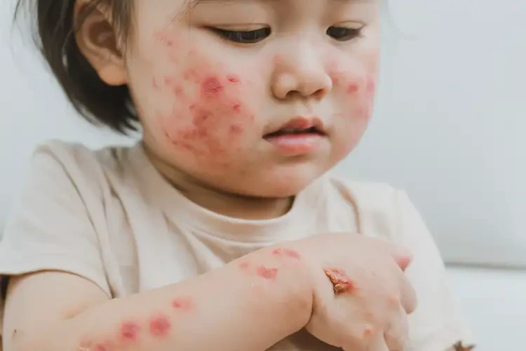 小兒身上出現(xiàn)濕疹不管它會(huì)自己好嗎(圖4)