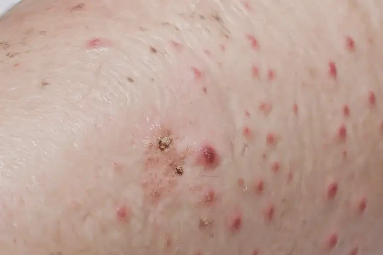 男生大腿经常起湿疹不管它会自己自愈吗(图3)