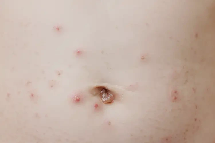 寶寶肚子經(jīng)常起濕疹能徹底自愈嗎(圖4)