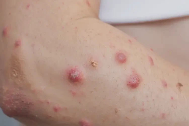 產(chǎn)婦手臂出濕疹能靠自己自愈嗎(圖4)