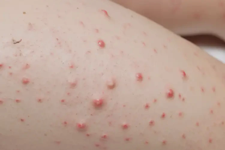 孩子大腿上出现湿疹能够彻底治愈吗(图4)