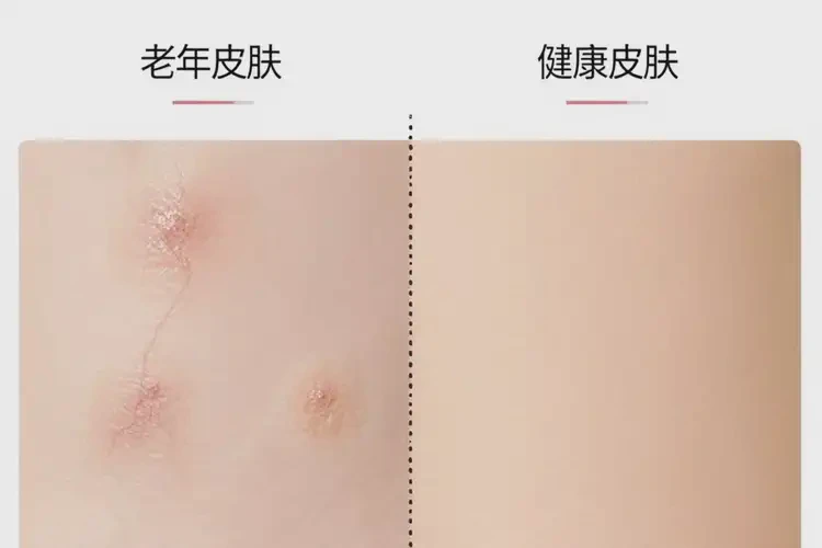 高齡老人大腿起濕疹可以徹底自愈嗎(圖3)
