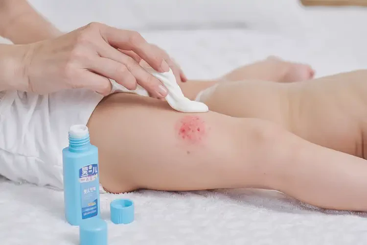 嬰兒屁股容易起濕疹不管它會自己好嗎(圖1)