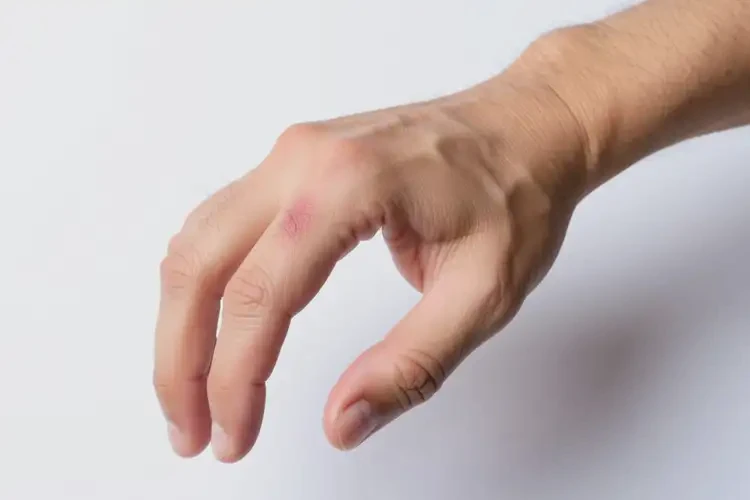 男性手上偶爾起濕疹不管它會(huì)自己好嗎(圖1)