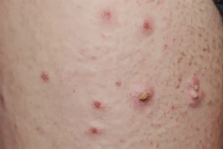 男生大腿長濕疹能夠徹底治愈嗎(圖4)