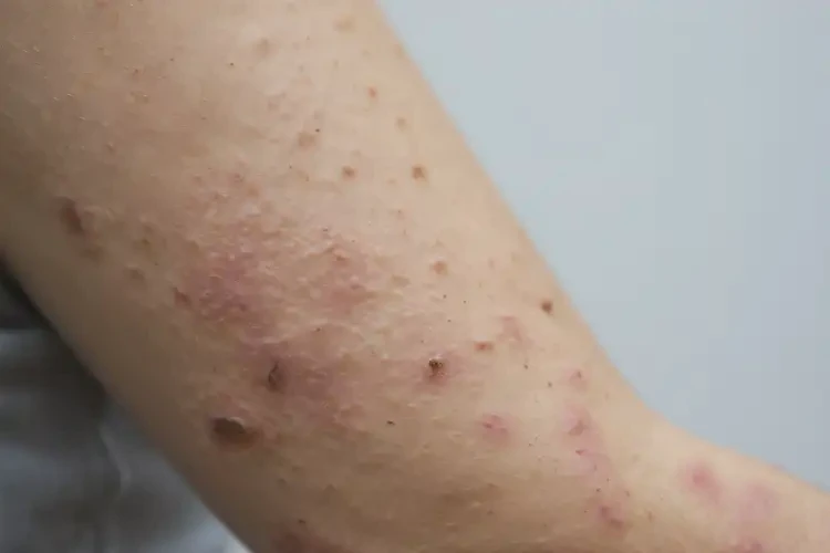 女人手臂長(zhǎng)濕疹能夠徹底治愈嗎(圖3)