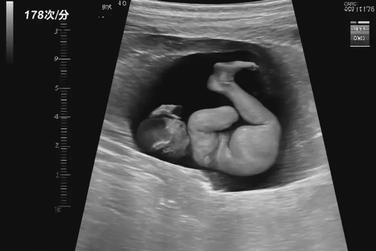 孕9周3天胎心176还要保胎吗(图4)