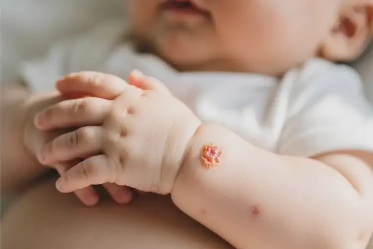 寶寶手臂上經(jīng)常起濕疹能徹底自愈嗎(圖3)
