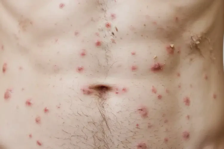 青年人肚子長濕疹可不可以徹底自愈(圖3)