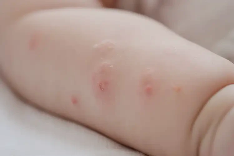 嬰兒手臂上經(jīng)常長濕疹不管它會自己好嗎(圖4)