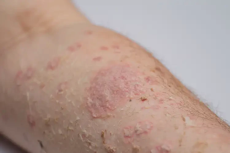 少儿全身长湿疹可不可以彻底自愈(图4)