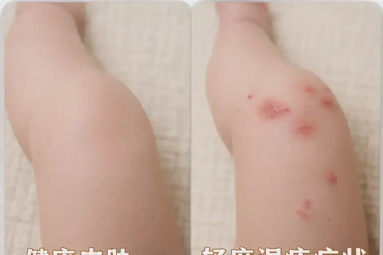 小儿大腿上偶尔长湿疹能靠自己自愈吗(图1)